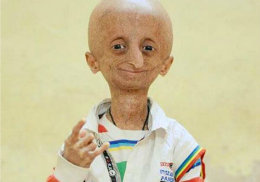 Băieţelul care suferă de “boala lui Benjamin Button” i-a uimit pe medici. Are 15 ani, dar arată de 80